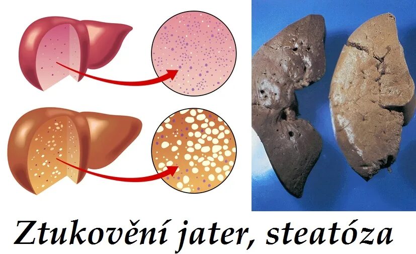 Жировой гепатоз (стеатоз) печени. Что такое стеатоз поджелудочной железы