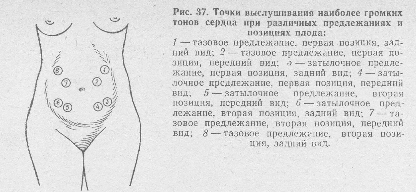Виды сердцебиения плода. Точки выслушивания сердцебиения плода. точки выслушивания сердцебиения плода при беременности. точка аускультации сердцебиения плода. выслушивание сердечных тонов плода.