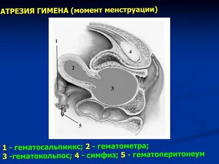 Гимен