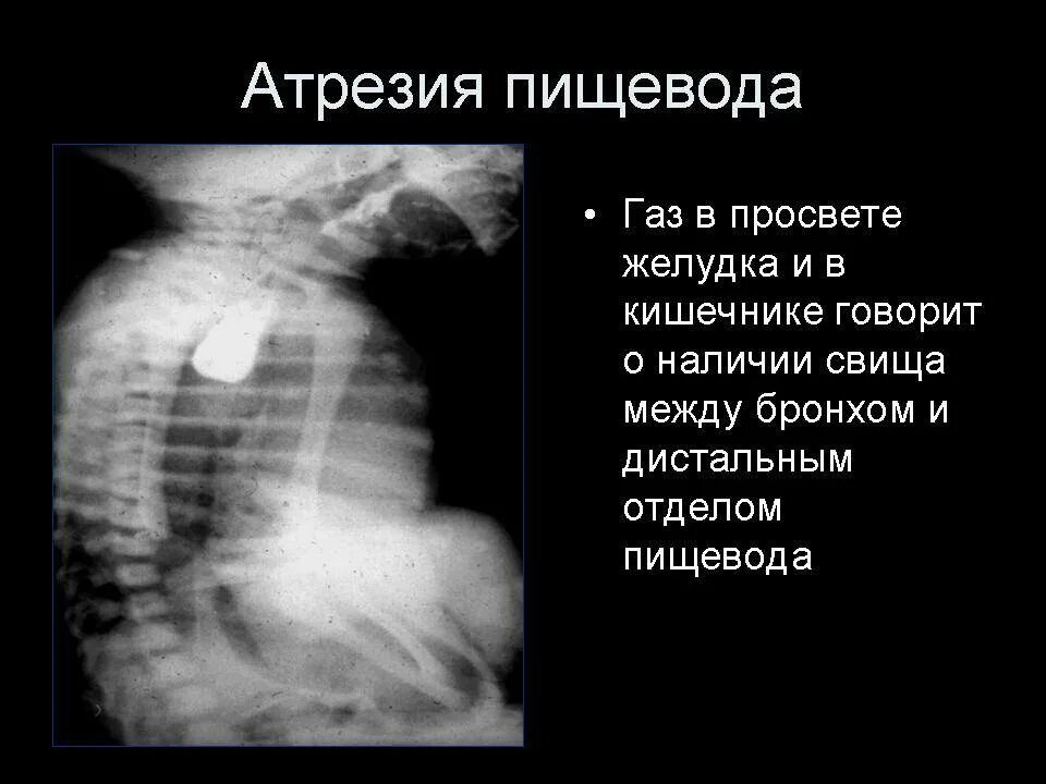 Атрезия пищевода. Рентген при атрезии пищевода. атрезия пищевода у детей рентген. врожденная патология атрезия пищевода. рентген атрезии пищевода симптомы.