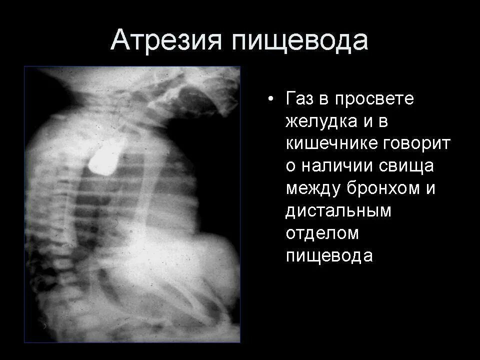 Рентген при атрезии пищевода. Пренатальная диагностика атрезии пищевода. Атрезия пищевода контрастное исследование. Атрезия пищевода эзофагоскопия. Слепой пищевод