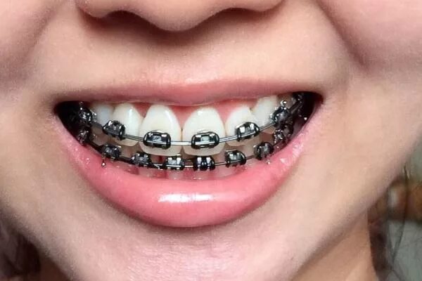 Как выглядят черные резинки на брекетах Как выглядят черные резинки на брекетах