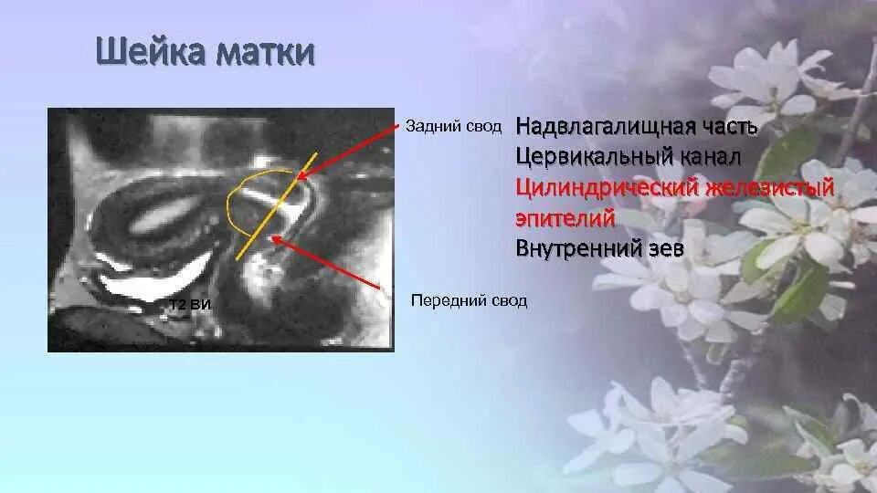 Задний свод матки. Задний свод шейки матки. Передний и задний свод матки. Шейка матки надвлагалищная часть. Задний свод шейки матки цервикальный канал.