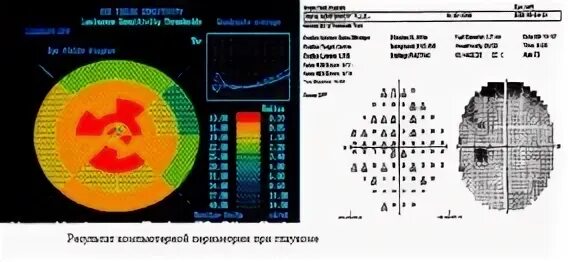 Компьютерная периметрия что это такое