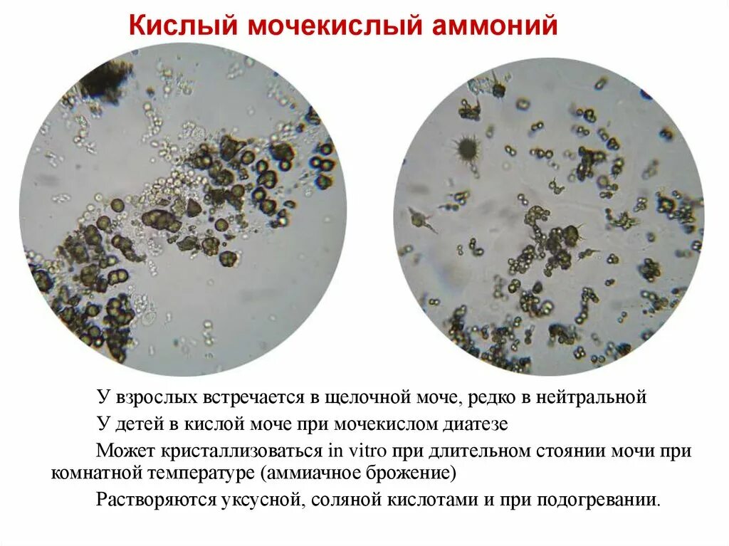 Микроскопия осадка мочи мочекислый аммоний. Кислый мочекислый аммоний в моче микроскопия. Кислый мочекислый аммоний в микроскопии мочи. Соли мочекислый аммоний.