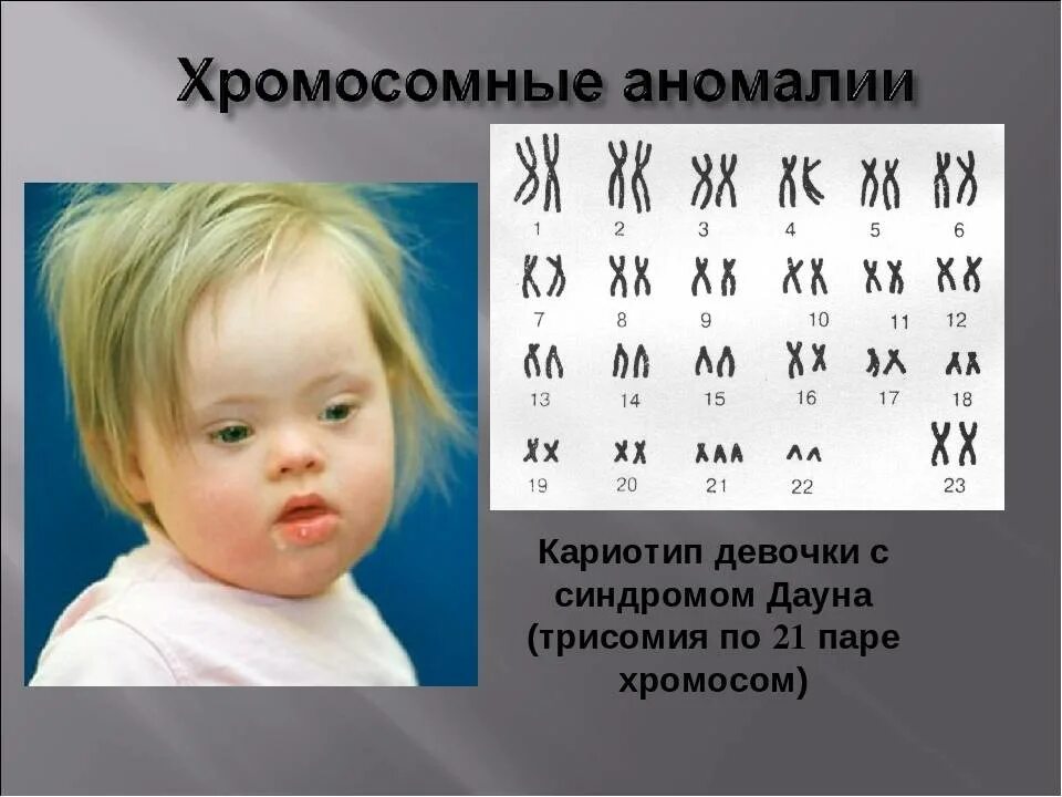 Синдром Дауна трисомия 21 хромосомы. Болезнь Дауна кариотип. Синдром Дауна трисомия 21. Кариотип синдрома дану.