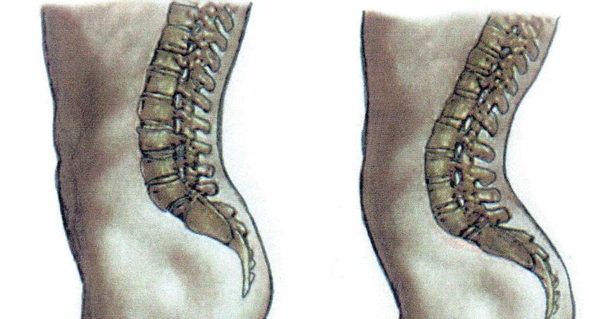 Лордоз позвоночника сглажен. Лордоз грудного отдела позвоночника. Лордоз усилен в поясничном отделе позвоночника. Лордоз поясничного отдела таз. Лордоз шейного отдела отдела.