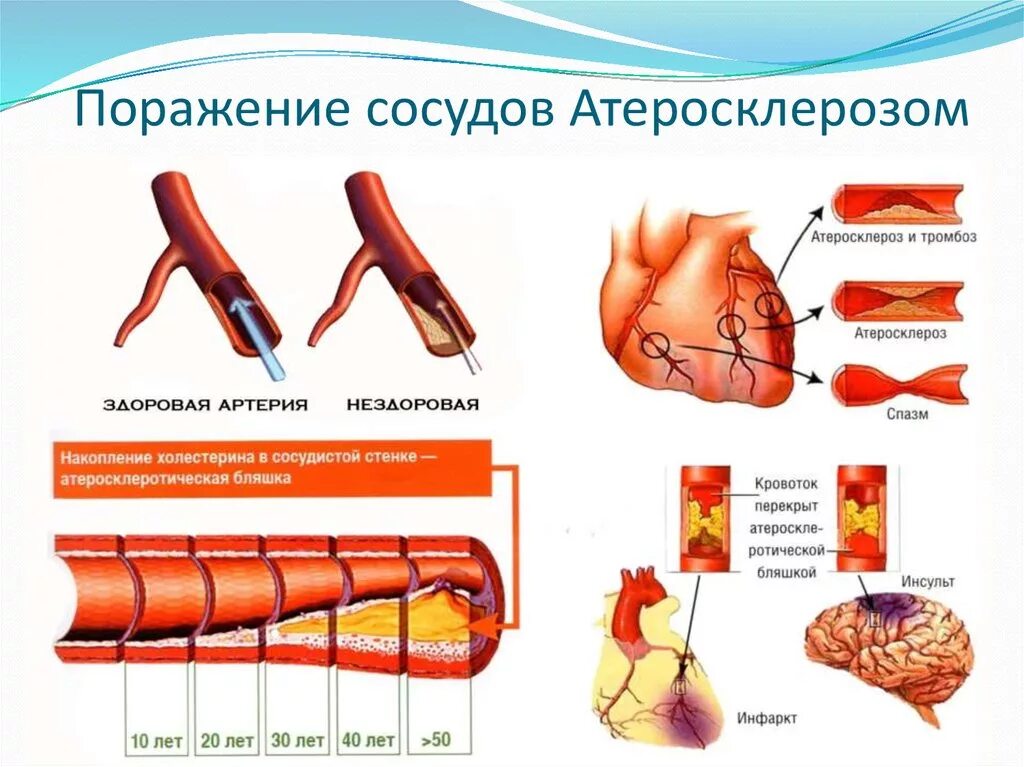 Артерий атеросклероз латынь. Атеросклероз бляшки сосудов. Атеросклероз сосудов показатели. Атеросклероз коронарных артерий препарат. Атеросклероз артерий симптомы.