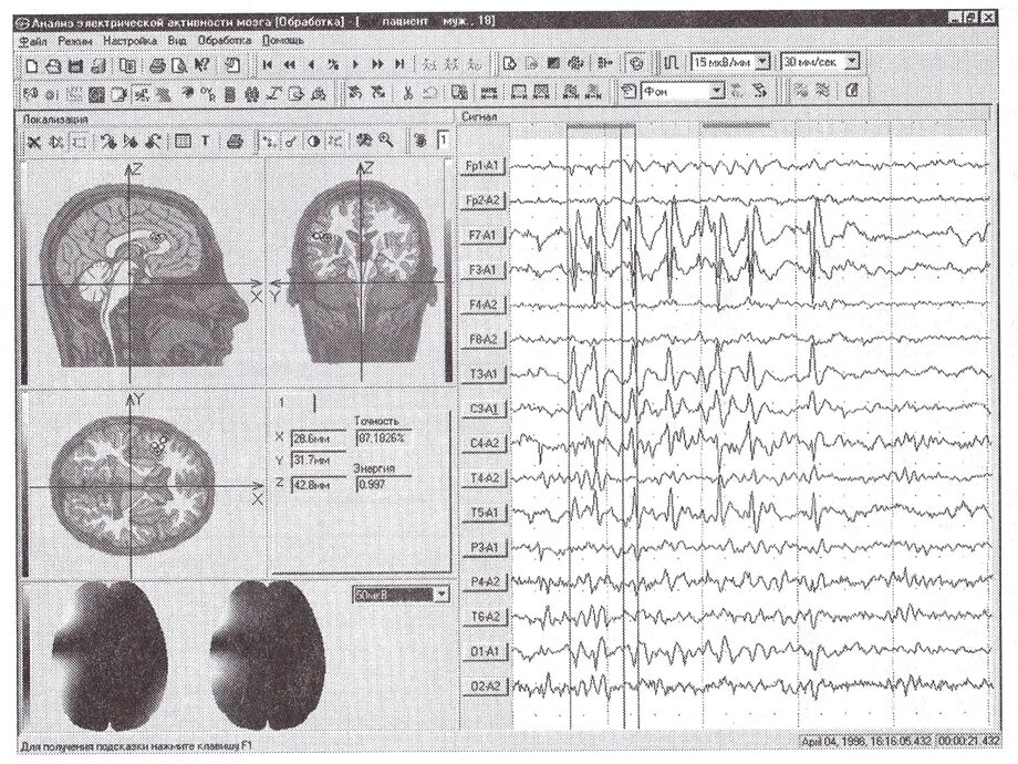 Атлас ЭЭГ Мухин. ЭЭГ картирование коры. Умственная отсталость на ЭЭГ. Энцефалан-131-03 программное обеспечение. Пароксизмальная активность мозга