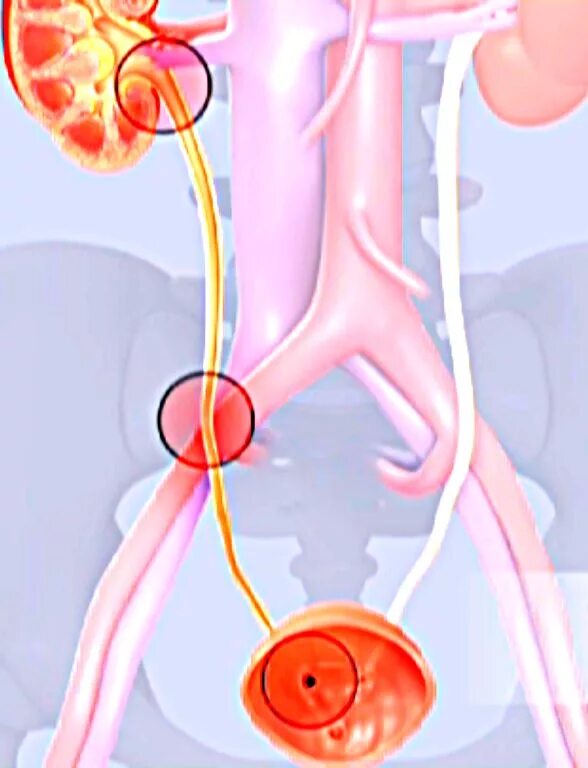 Ощущений мочеточник. Камень в 1/3 мочеточника у женщин. Камень в устьях мочеточника. Устье мочеточника у мужчин камень. Стентирование мочевого канала у мужчин.