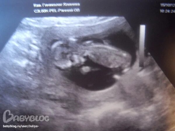 положение плода узи. узи плод на 20 недели тазовом предлежании. расположение плода на узи. ультразвуковое исследование (узи) плода. узи плода на 28 неделе беременности.