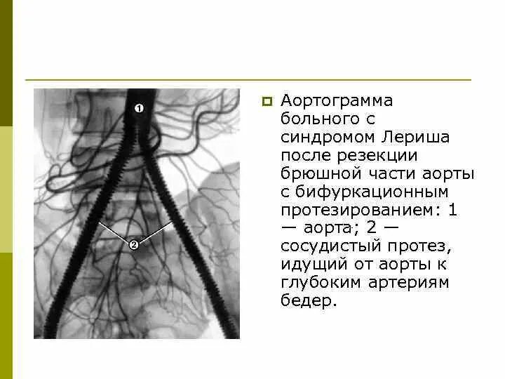 Атеросклероз аорты синдром Лериша. Синдром Лериша ангиография.