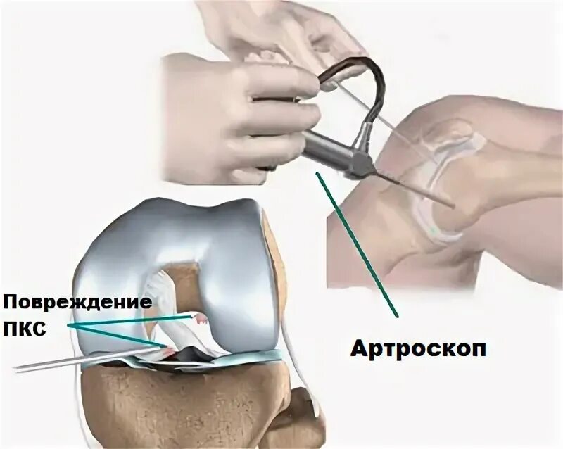 Разрыв связок коленного сустава ПКС операция. Артроскопия коленного сустава разрыв ПКС. Артроскопическая пластика коленного сустава. Разрыв передней крестообразной связки коленного сустава операция. Передняя крестообразная связка после операции