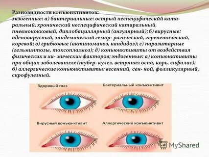 Конъюнктивит воздушно капельным