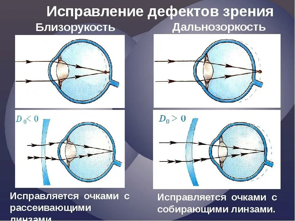 Как можно скорректировать дальнозоркость. Дефекты зрения близорукость и дальнозоркость. Какими линзами корректируется близорукость и дальнозоркость. Коррекция линзами дефектов зрения. Линзы для коррекции миопии (близорукости).