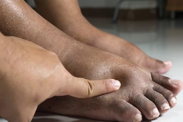Лечение отечности ног у пожилых