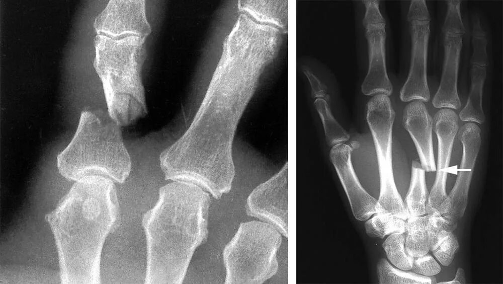 Перелом пястных костей рентген. Рентген кисти перелом пястной кости. Переломы диафизов пястных костей.