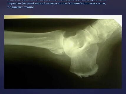 Подвывих после перелома