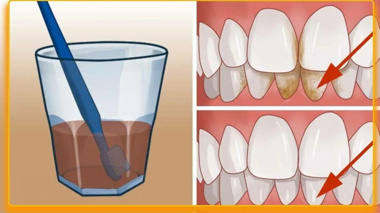 Коричневый зубной камень. Неприятное ощущение на зубах