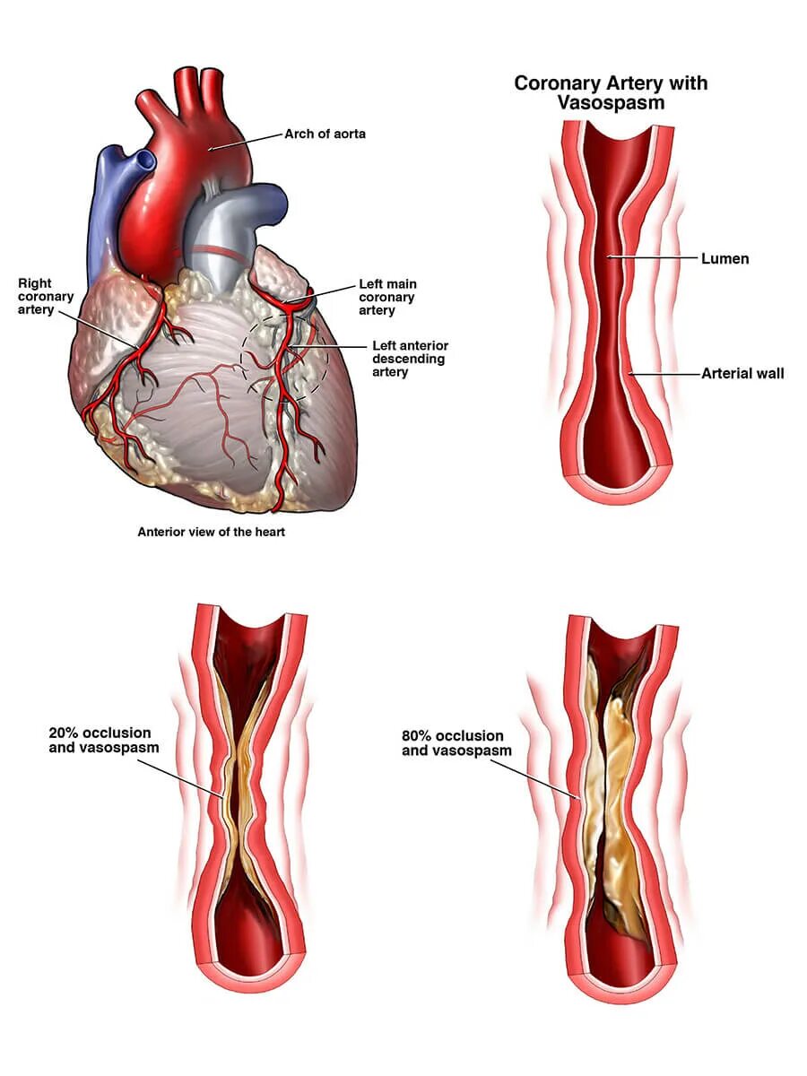 Coronary heart disease. Атеросклероз коронарных артерий. Атеросклероз ибс стенокардия. Ишемическая болезнь сердца картинки для презентации. Coronary heart disease.
