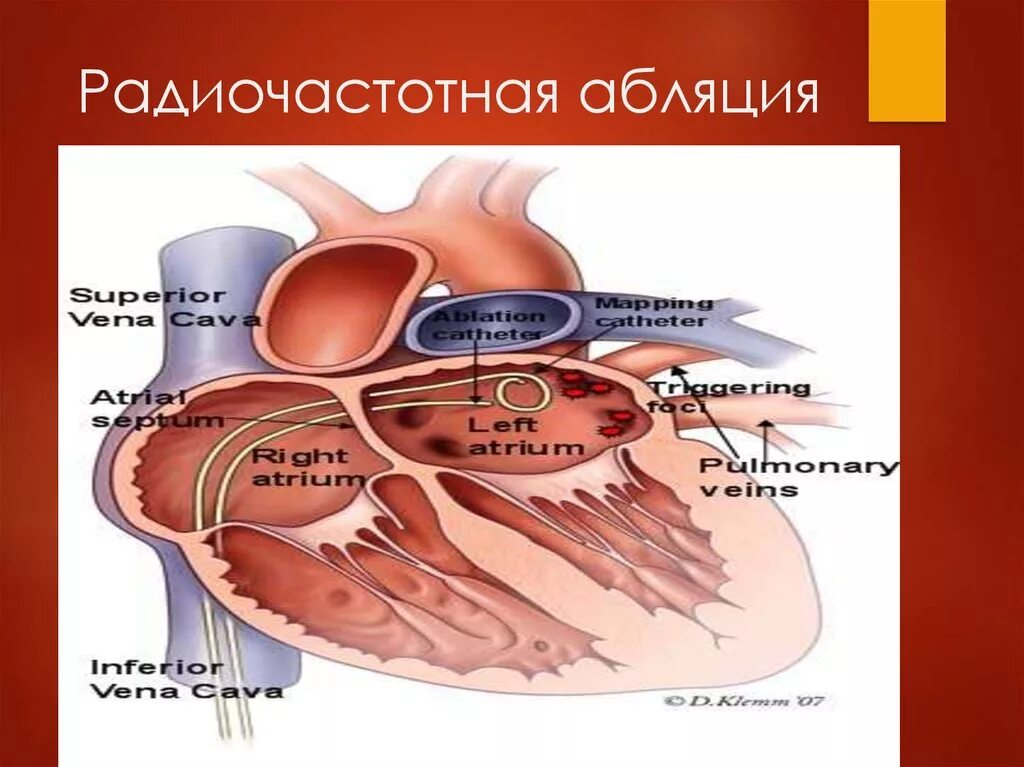 Где делают абляцию. Радиочастотная катетерная абляция. Катетерная абляция сердца что это такое. Высокочастотная абляция. Радиационная абляция сердца.