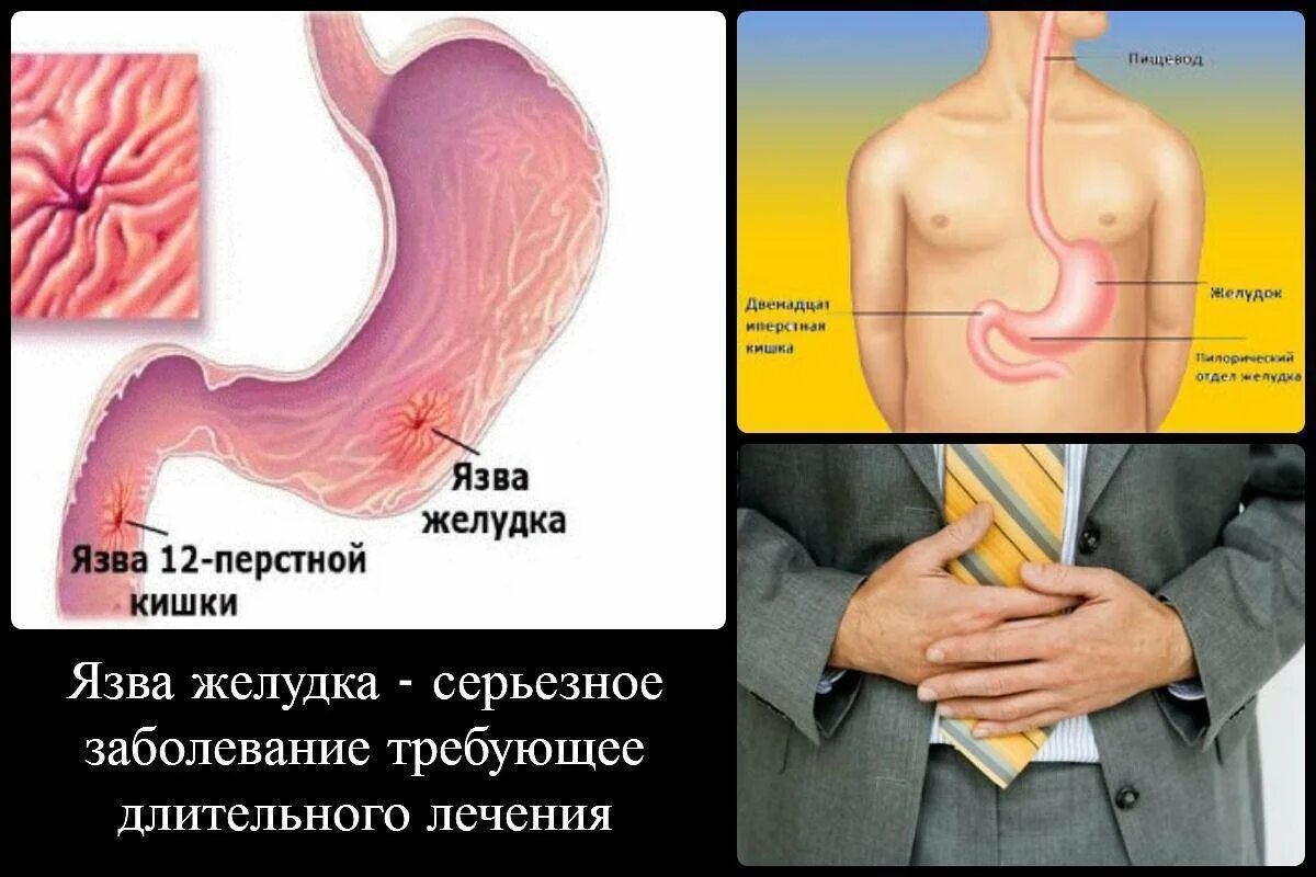 Язва желудка и 12 перстной кишки. Проявления язвенной болезни желудка и 12-перстной кишки.. Основные симптомы язвенной болезни желудка и 12-перстной кишки. Язвенная болезнь двенадцатиперстной симптомы. Живот при язве желудка