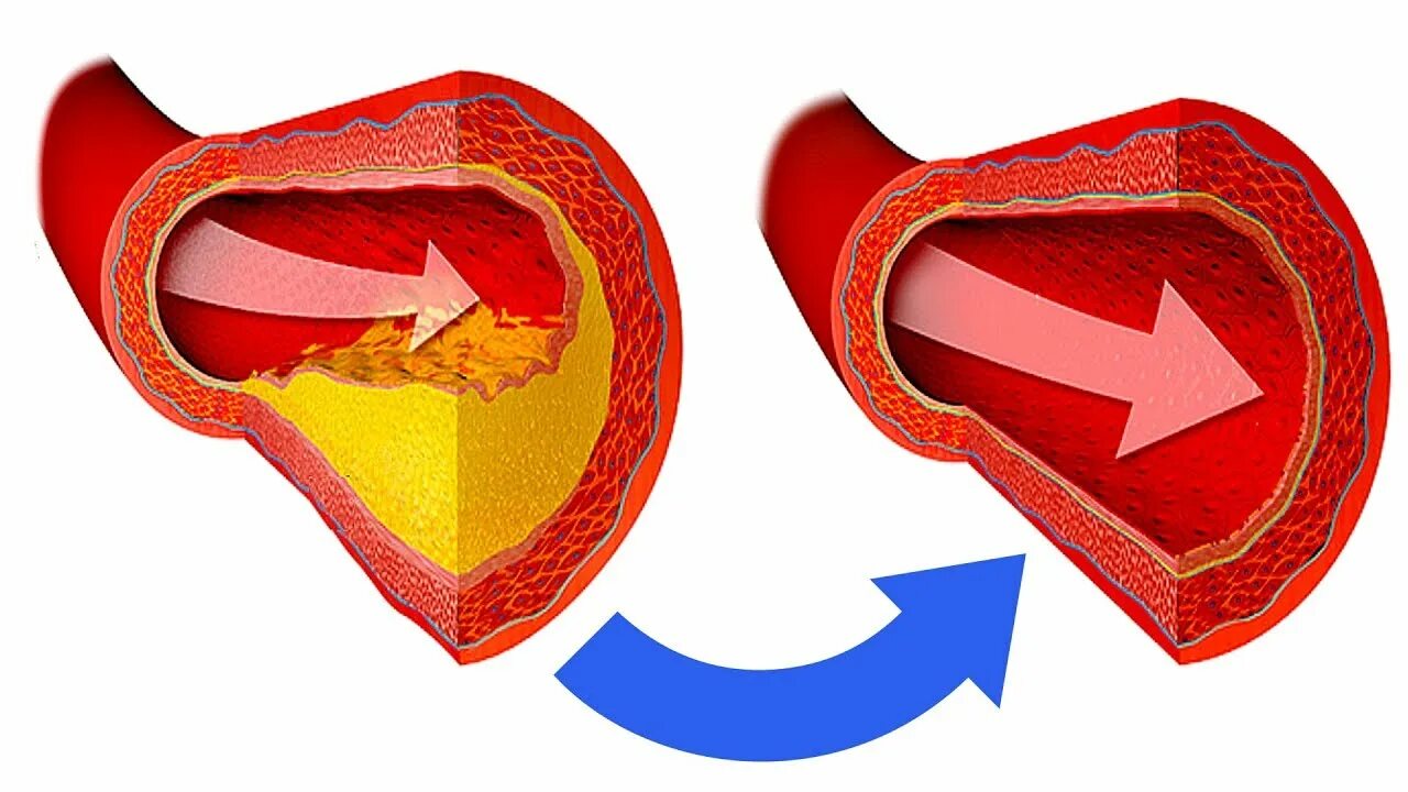 Очистка сосудов от бляшек. Нестенозирующий атеросклероз.