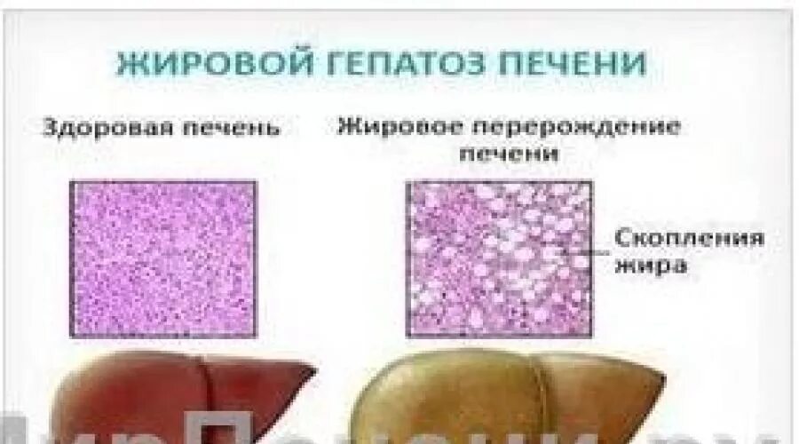 Гепатоз печени что это такое причины лечение. Жировой гепатоз печени таблетки. гепатопротекторы жировой гепатоз. жировой гепатоз печени сыпь. таблетки от жирового гепатоза.