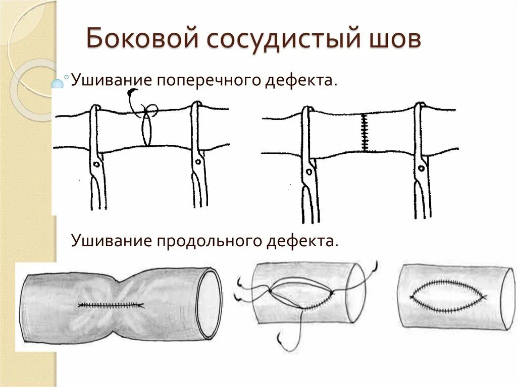 Стерильный шов. Сосудистый шов по Сапожникову. Боковой шов сосудистый шов. Методика наложения сосудистого шва. Боковой и циркулярный сосудистые швы.