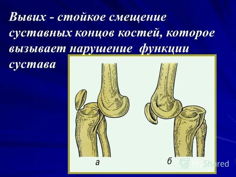 Вывих сустава закрытый перелом разрыв сухожилия