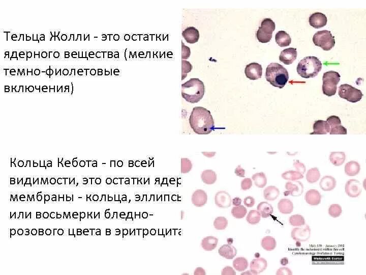 Тельца гейнца. Тельца Жолли и кольца Кебота. В эритроцитах кольца Кебота тельца Жолли. Тельца Хауэлла Жолли. Тельуп Жоли еольуп кебоьа.