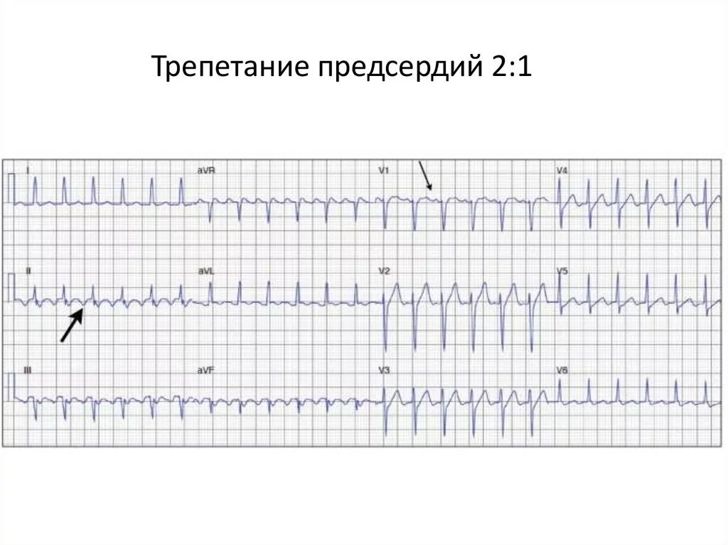 Трепетание предсердий 2 к 1 на ЭКГ. Трепетание предсердий правильная форма 2 1 на ЭКГ. Трепетание предсердий 1 к 1 на ЭКГ. Трепетание предсердий правильная форма 1 1. Формы трепетания предсердий