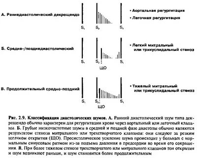 Шум при митральном стенозе