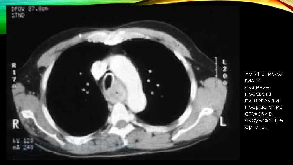 Кт пищевода и желудка. Кт при опухоли пищевода.
