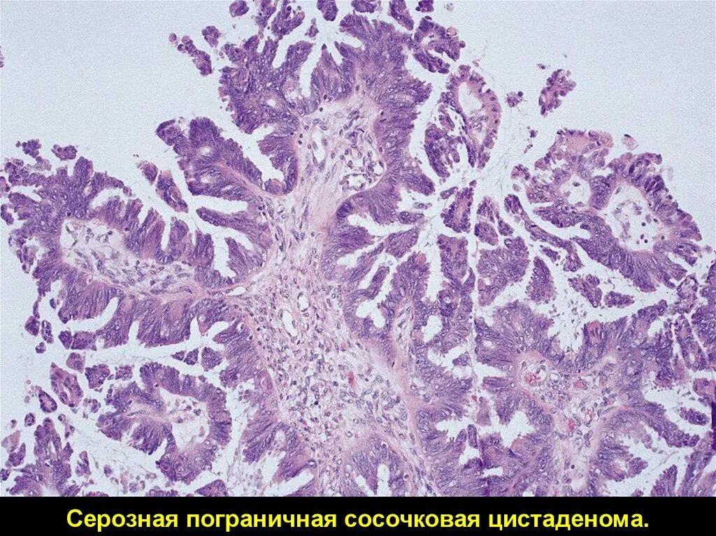 Цистаденокарцинома серозная папиллярная гистология. Цистаденома яичника гистология. Муцинозная цистаденома гистология. Цистаденома гистология. Серозная пограничная опухоль