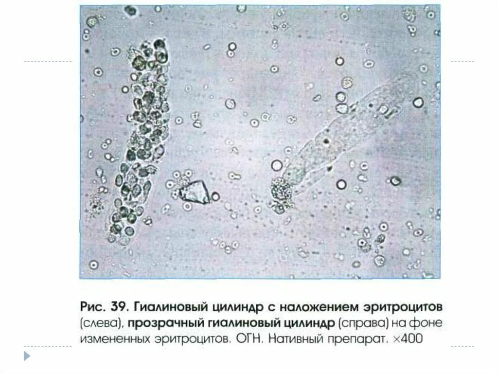 Моча цилиндры гиалиновые повышенные. Гиалиновые цилиндры микроскопия. Гиалиновый цилиндр в моче микроскопия. Простатический сок микроскопия. Моча микроскопия.