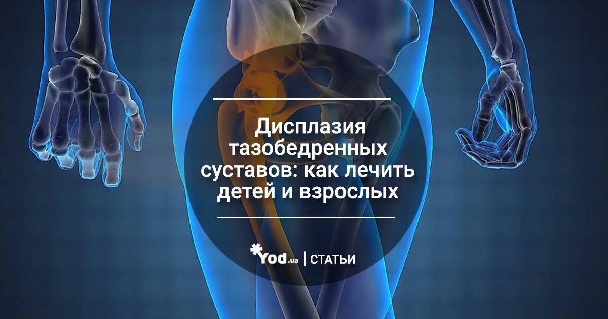 Дисплазия лечение народными. Дисплазия тазобедренных суставов. дисплазия тазобедренных суставов у взрослых. тазобедренная дисплазия у взрослых. дисплазия суставов у взрослых.