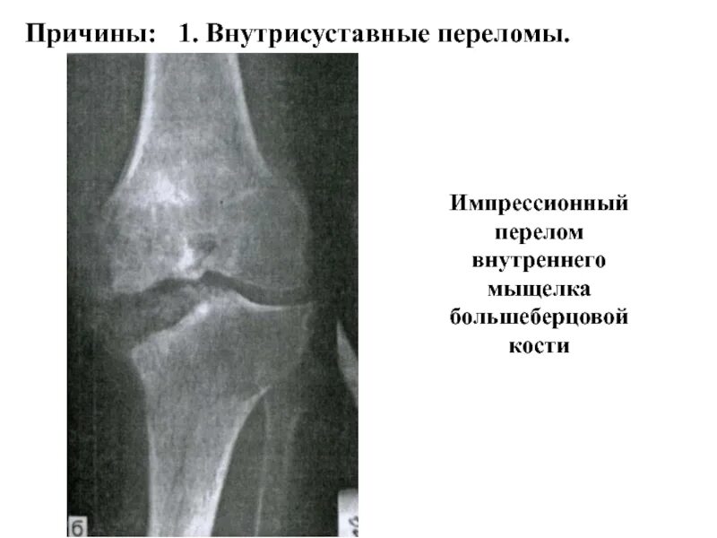 Мыщелок большеберцовой кости фото. Импрессионный перелом внутреннего мыщелка. импрессионный перелом наружного мыщелка большеберцовой кости. импрессионный перелом мыщелка большеберцовой кости на кт. импрессионный перелом мыщелка большеберцовой кости рентген.