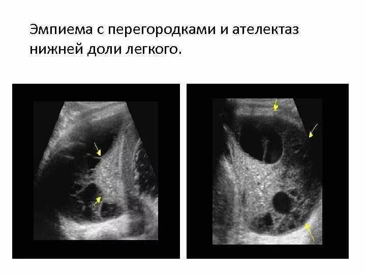 Тотальная эмпиема плевры рентген. Полость эмпиемы. Полость эмпиемы. Эмпиема плевры макропрепарат. Полость эмпиемы.