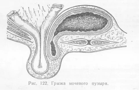 Мочевой грыжа