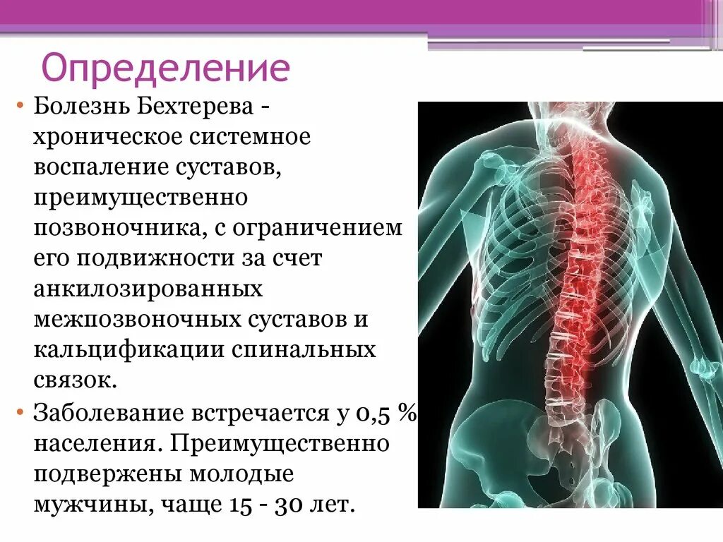 Анкилозирующий спондилоартрит болезнь Бехтерева. Анкилозирующий спондилит болезнь Бехтерева. Анкилозирующий спондилез это болезнь Бехтерева. Суставной синдром при болезни Бехтерева.