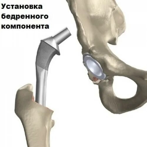 Эндопротезирование шейки бедра. Туннелизация шейки бедренной кости. Перелом шейки бедра реабилитация этапы. Перелом шейки бедра фиксация. После эндопротезирования шейки бедра