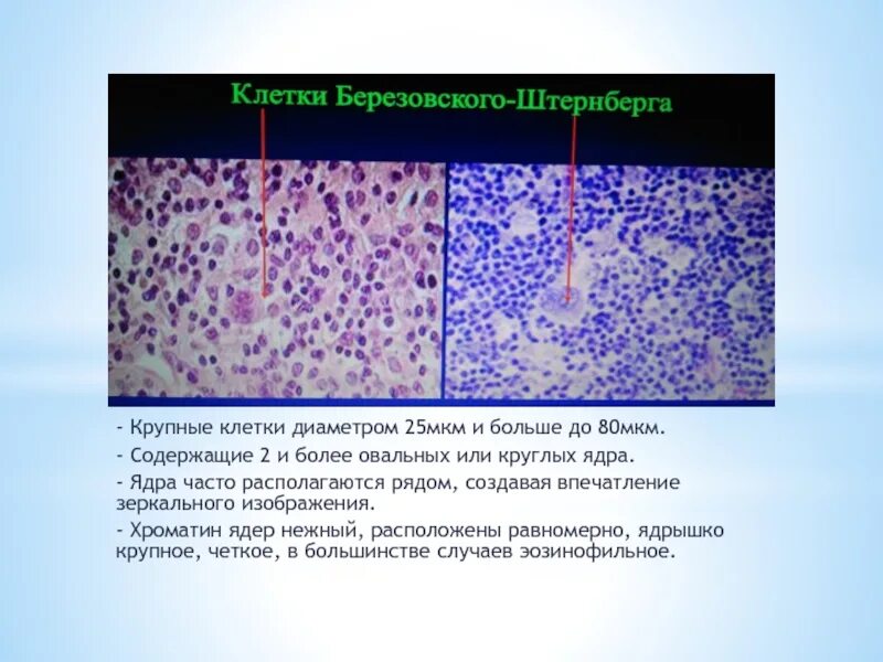 Клетки рида. Лимфогранулематоз клетки Березовского Штернберга. Клетки Рид-Березовского-Штернберга и клетки Ходжкина. Клетки Рида Березовского Штернберга.