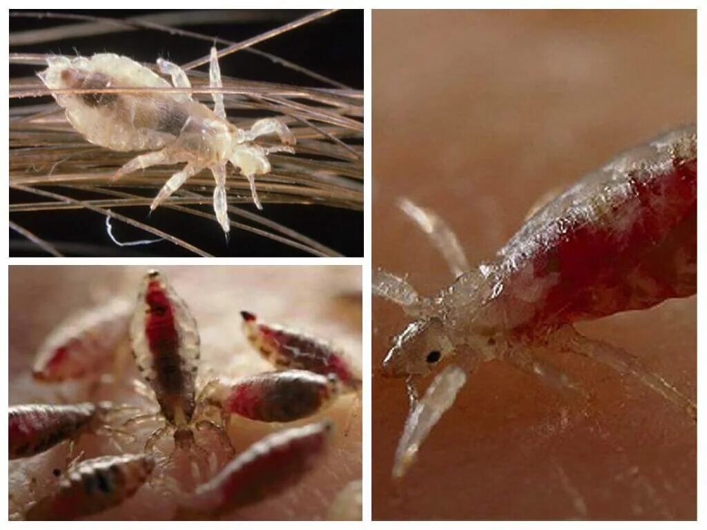 Какие виды вшей. Какие виды вшей. Какие виды вшей. Экскременты платяной вши. Вши головная платяная лобковая.