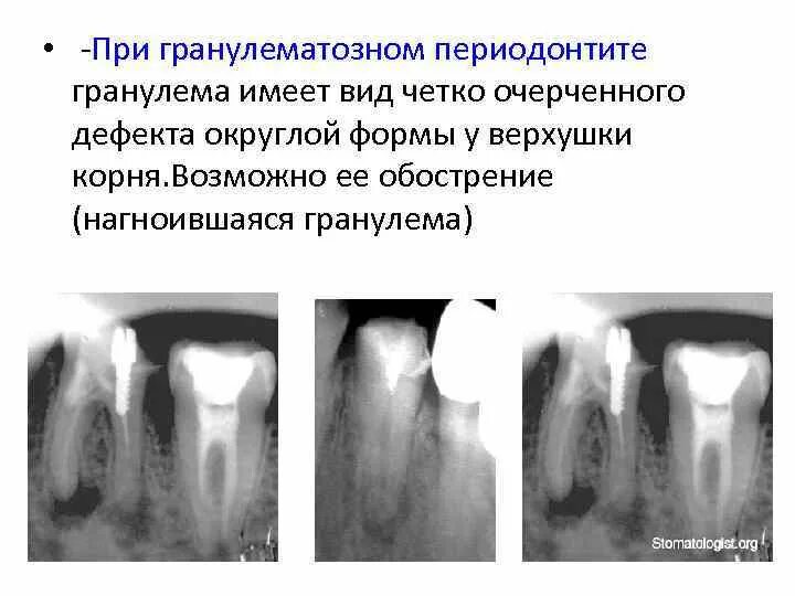 Фиброзный периодонтит