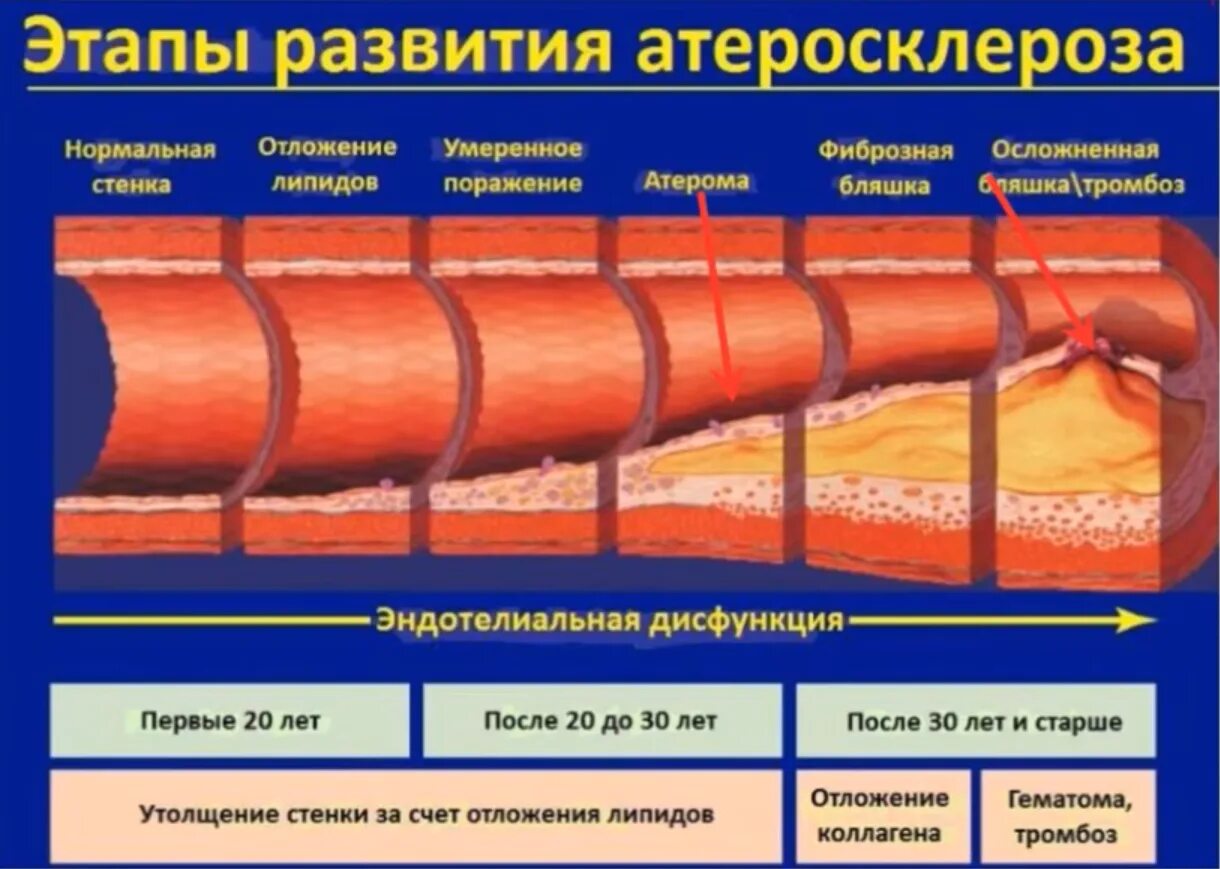 Стадии атеросклероза артерий. Стадии атеросклероза артерий