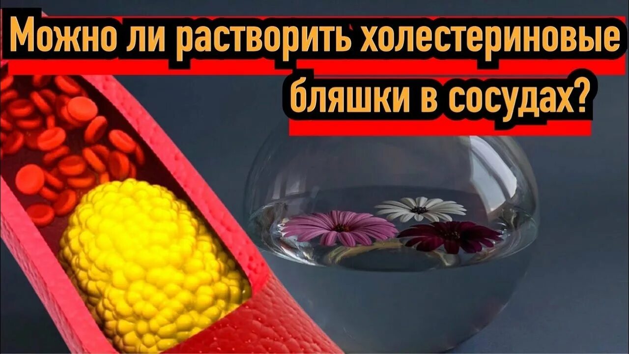 Здоровые сосуды. Атеросклеротическая бляшка. Атеросклероз бляшка модель. Холестериновые бляжки. Что растворяет холестериновые бляшки.