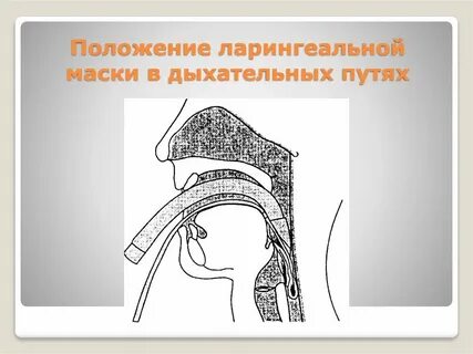 Попало в дыхательное горло что делать