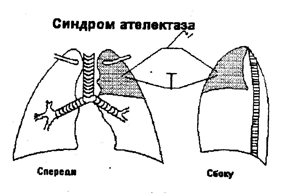 Спадение бронха