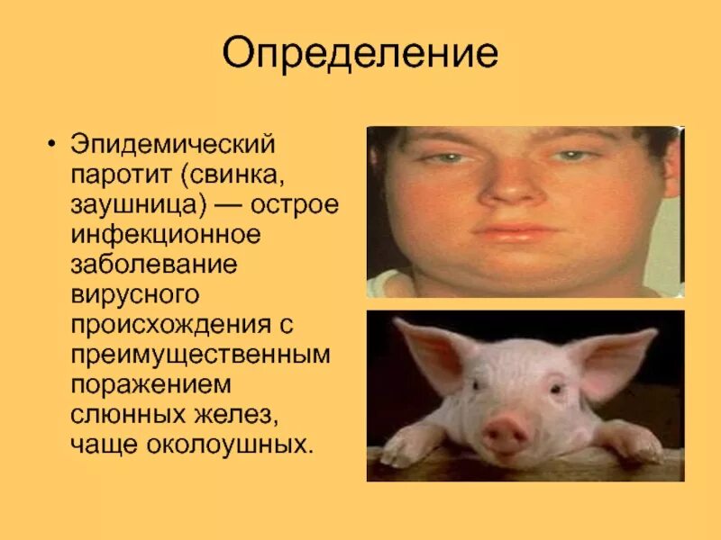 Какие признаки свинки. Свинка эпидемический паротит. Эпидемический паротит Свинка болезнь. Свинка болезнь название. Свинка вирусное заболевание.